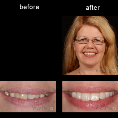 Short-Term Ortho Six Month Smiles and CEREC restorations
